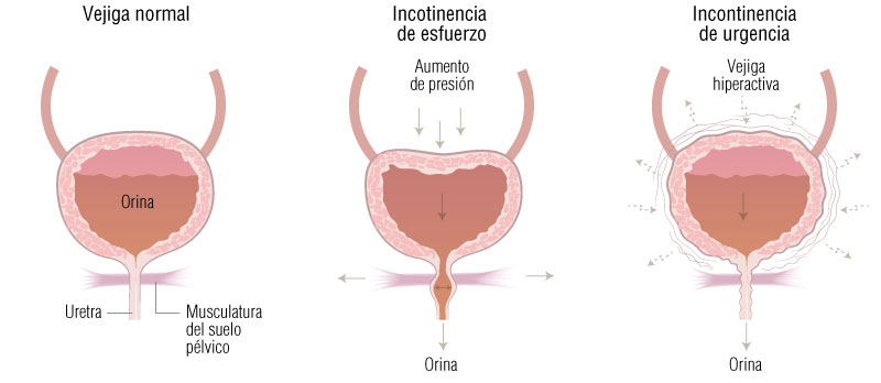 Ginestética: uroginecología, urología, propaso, incontinencia urinaria.